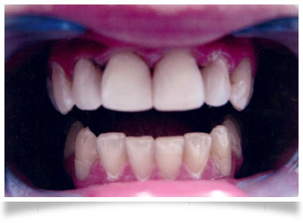 Composite Restorations