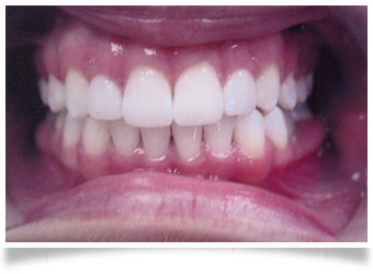 Composite Veneers