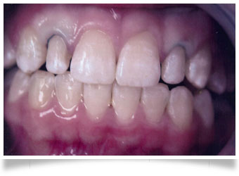 Composite Veneers