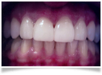 porcealin veneers after