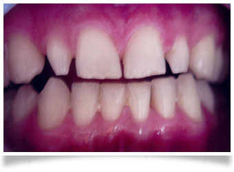 veneers 